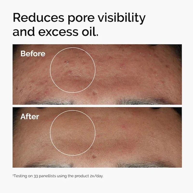 Niacinamide 10% + Zinc 1% Serum 30ml A Universal Essence Suitable for Acne-prone Skin Which Can Smooth Brighten Support The Skin
